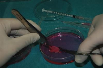 Γυναίκα γέννησε με ωοθήκη που είχε καταψύξει ως έφηβη